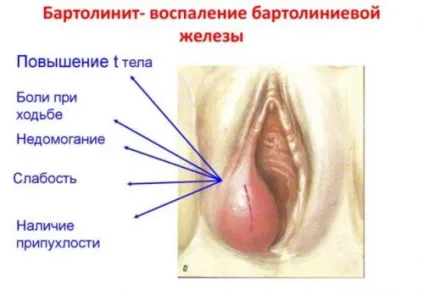 Кіста бартолінової залози, лікування без операції, народними засобами (оперативне) Кіста бартолінової залози, лікування без операції, народними засобами