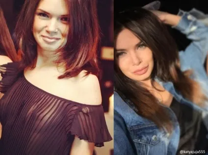 Катя жужа фото до і після пластики - 300 (пластики) Катя жужа фото до і після пластики - 300