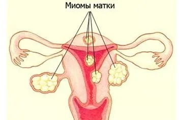 Що таке міома матки і методи боротьби з нею (активне ділення клітин) Що таке міома матки і методи боротьби з нею