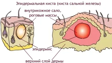 Що таке жировик, і чим він небезпечний на спині, голові, під шкірою (чим небезпечний жировик на голові) Що таке жировик, і чим він небезпечний на спині, голові, під шкірою