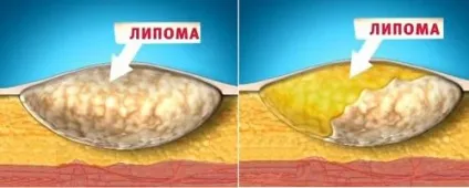 Що таке жировик, і чим він небезпечний на спині, голові, під шкірою (чим небезпечні жировики під шкірою) Що таке жировик, і чим він небезпечний на спині, голові, під шкірою