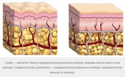 Що таке целюліт - лікування, причини, симптоми, ознаки, як позбутися целюліту (лікування) Що таке целюліт - лікування, причини, симптоми, ознаки, як позбутися целюліту