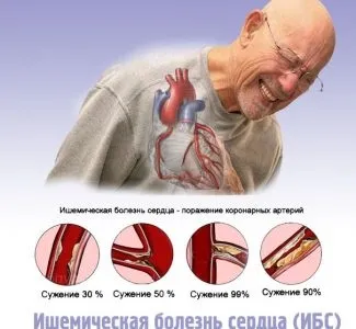 Cубендокардіальная ішемія ознаки на ЕКГ