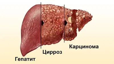 Цироз печінки - це рак чи ні