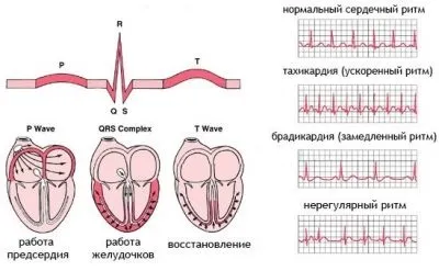 Cубендокардіальная ішемія ознаки на ЕКГ