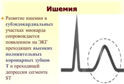 Cубендокардіальная ішемія ознаки на ЕКГ