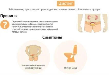 Цистит, симптоми у чоловіків і як лікувати народними засобами (цистит) Цистит, симптоми у чоловіків і як лікувати народними засобами