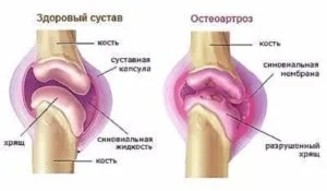 Деформуючий остеоартроз поняття, клініка, діагностика (клініка) Деформуючий остеоартроз поняття, клініка, діагностика