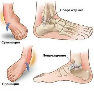 Деформуючий остеоартроз симптоми, діагностика та лікування (деформуючий остеоартроз код по МКБ 10 гомілковостопного суглоба стопи лікування історія хвороби) Деформуючий остеоартроз симптоми, діагностика та лікування