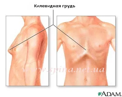 Деформації грудної клітини лікування в інституті ортопедії (воронкообразная деформація грудної клітини) Деформації грудної клітини лікування в інституті ортопедії