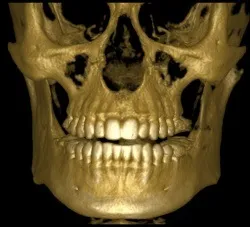 Дентальний комп'ютерний 3d томограф, стоматологічне об'ємне сканування зубів