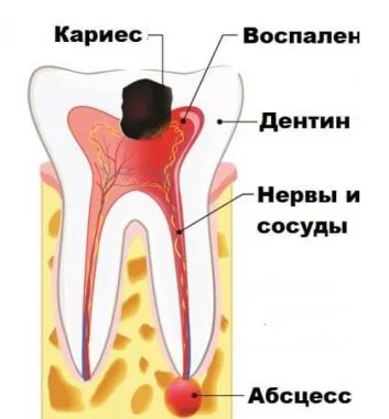 Десневой кишеню причини запалення і способи лікування (лікування) Десневой кишеню причини запалення і способи лікування