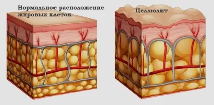 Дієта від целюліту на ногах і попі відгуки, меню на 10 днів, список корисних продуктів (меню) Дієта від целюліту на ногах і попі відгуки, меню на 10 днів, список корисних продуктів