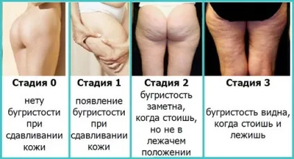 Дієта від целюліту на ногах і попі відгуки, меню на 10 днів, список корисних продуктів (целюліту) Дієта від целюліту на ногах і попі відгуки, меню на 10 днів, список корисних продуктів