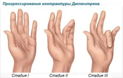 Діагностування і лікування контрактури суглобів і м'язів, контрактура Дюпюітрена