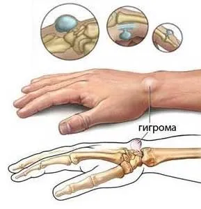 Для чого потрібні кистьові бинти (кистьові) Для чого потрібні кистьові бинти
