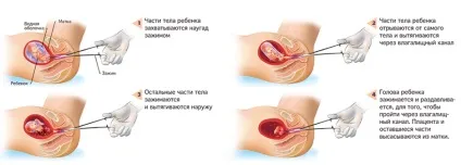 До якого терміну можна робити аборт без шкоди здоров'ю жінки (якого) До якого терміну можна робити аборт без шкоди здоров'ю жінки