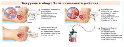 До якого терміну можна робити аборт без шкоди здоров'ю жінки (можна) До якого терміну можна робити аборт без шкоди здоров'ю жінки