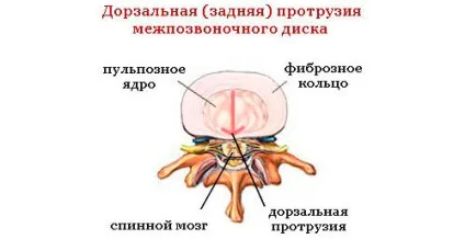Дорзальная дифузна грижа міжхребцевого диска - що це таке, симптоми і лікування (таке) Дорзальная дифузна грижа міжхребцевого диска - що це таке, симптоми і лікування