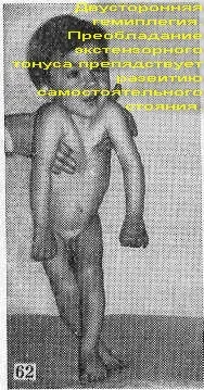 Двостороння геміплегія (подвійна геміплегія) (підняти голову спертися) Двостороння геміплегія (подвійна геміплегія)
