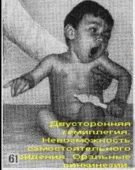 Двостороння геміплегія (подвійна геміплегія) (підняти голову спертися) Двостороння геміплегія (подвійна геміплегія)