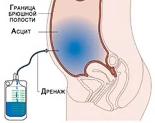 Дренування черевної порожнини - особливості проведення