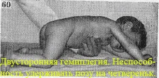 Двостороння геміплегія (подвійна геміплегія) (підняти голову спертися) Двостороння геміплегія (подвійна геміплегія)