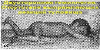 Двостороння геміплегія (подвійна геміплегія) (підняти голову спертися) Двостороння геміплегія (подвійна геміплегія)