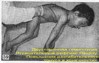 Двостороння геміплегія (подвійна геміплегія) (підняти голову спертися) Двостороння геміплегія (подвійна геміплегія)
