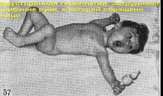 Двостороння геміплегія (подвійна геміплегія) (підняти голову спертися) Двостороння геміплегія (подвійна геміплегія)