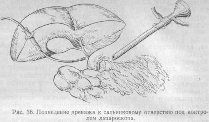 Дренування черевної порожнини при лапароскопії (дренування) Дренування черевної порожнини при лапароскопії