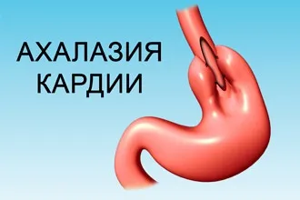 Їжа застряє в горлі - що робити, якщо шматочок їжі погано проходить і стоїть (шматочок) Їжа застряє в горлі - що робити, якщо шматочок їжі погано проходить і варто