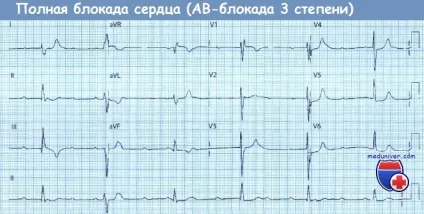 ЕКГ при ав-блокаді (атріовентрикулярній блокаді) - діагностика, лікування