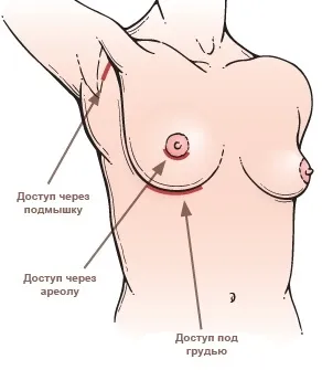 Ендопротезування грудей - секрети збільшення молочних залоз від пилипа містакопуло (збільшення грудей) Ендопротезування грудей - секрети збільшення молочних залоз від пилипа містакопуло