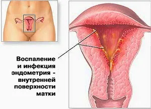 Ендоміометрит, симптоми, ознаки