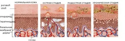 Екзема на руках фото, причини, стадії, ніж лікувати (стадії) Екзема на руках фото, причини, стадії, ніж лікувати