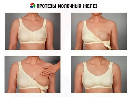 Екзопротези молочної залози навіщо вони потрібні, фото і відео відгуки (залози) Екзопротези молочної залози навіщо вони потрібні, фото і відео відгуки