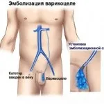 Епідидиміт, основні причини, характерні симптоми і методи лікування