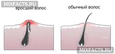 Епіляція без вростання волосся тонкощі проведення процедури (епіляція і вростання волосся) Епіляція без вростання волосся тонкощі проведення процедури