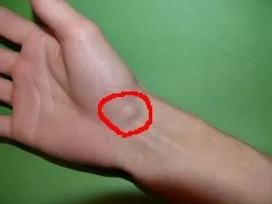 Фіброма на руці, що робити