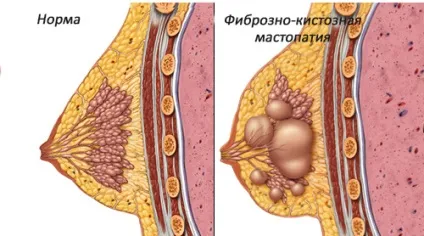Фіброзно-кістозна мастопатія симптоми лікування народними засобами (симптоми) Фіброзно-кістозна мастопатія симптоми лікування народними засобами