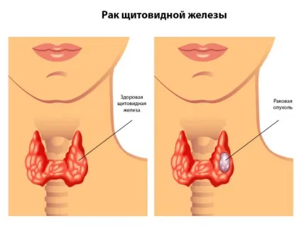 Фолікулярний рак щитовидної залози ступеня (1, 2, 3, 4), лікування пухлини, в тому числі за допомогою (пухлини) Фолікулярний рак щитовидної залози ступеня (1, 2, 3, 4), лікування пухлини, в тому числі за допомогою