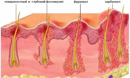 Фурункули на лобкової частини причини і лікування