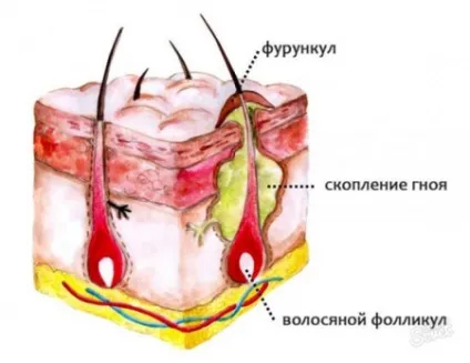 Фурункул і чиряк чим відрізняються