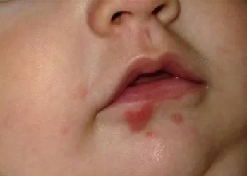 Герпес у грудничка