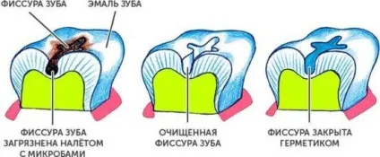 Герметизація фісур у дітей що це, показання, вартість (показання) Герметизація фісур у дітей що це, показання, вартість