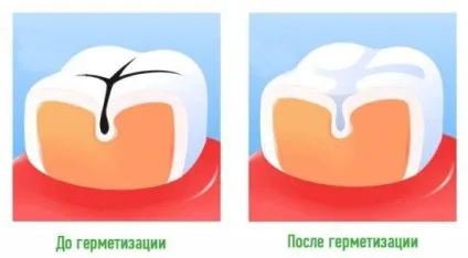 Герметизація фісур у дітей що це, показання, вартість (герметизація) Герметизація фісур у дітей що це, показання, вартість