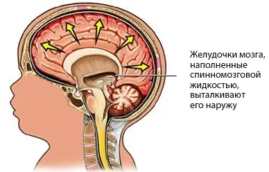 Гідроцефалія плода - лікування хвороби (лікування хвороб) Гідроцефалія плода - лікування хвороби