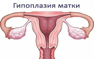 Гіпоплазія матки причини, симптоми і діагностика (симптоми) Гіпоплазія матки причини, симптоми і діагностика