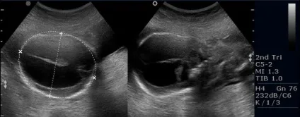 Гідроцефалія плода - лікування хвороби (гідроцефалія плоду симптоми) Гідроцефалія плода - лікування хвороби
